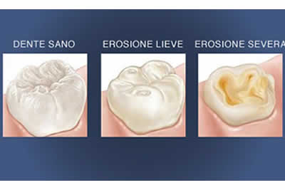 erosione-dentale.jpg