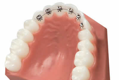 ortodonzia-linguale.jpg